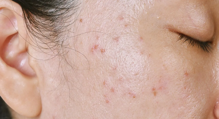 How to Get Rid of White Pores_ Tips for Clear, Smooth Skin